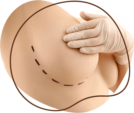 Breast reduction