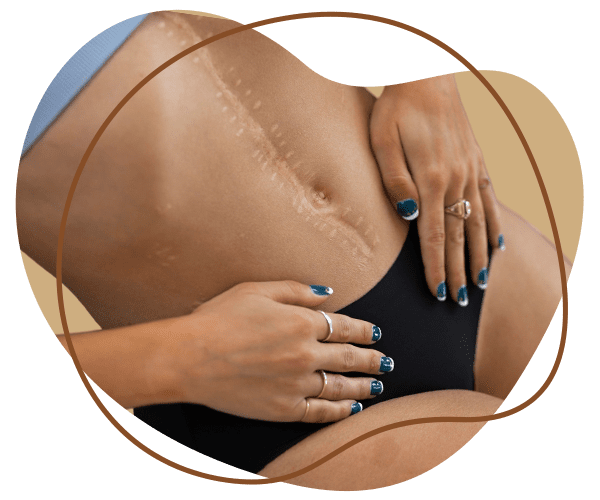 Stretch Marks Removal