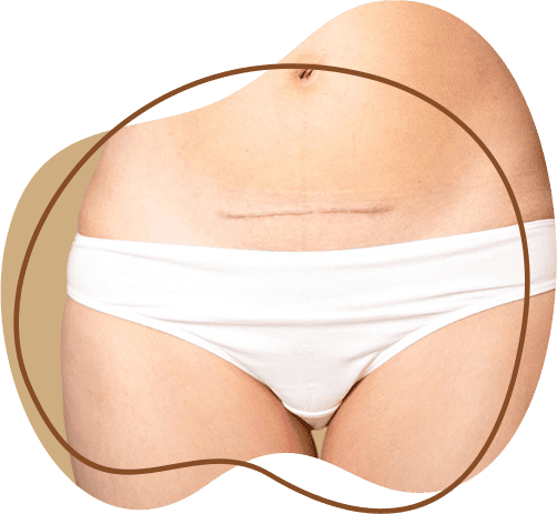 laser scar removal